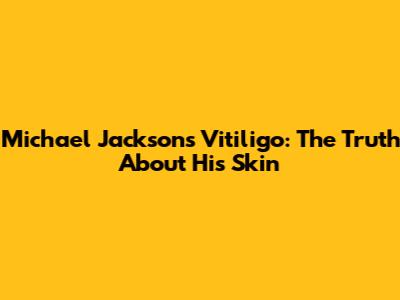 Michael Jackson's Vitiligo: The Truth About His Skin