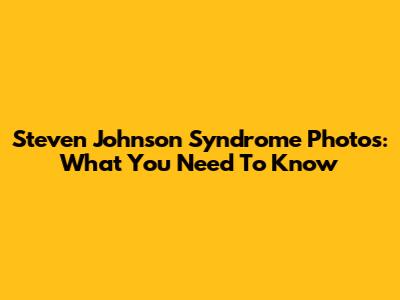 Steven Johnson Syndrome Photos: What You Need To Know